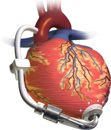 Left Ventricular Assist Device (LVAD)