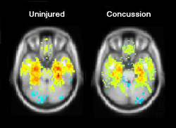 Comparision of brain scans before and after a concussion