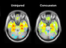 Comparision of brain scans before and after a concussion